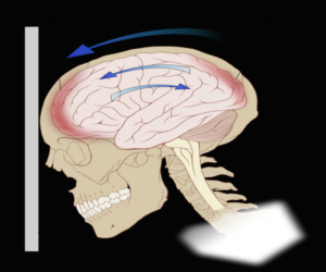 neurofeedback-and-TBI